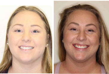 Before and after dental treatment at Chun Orthodontics